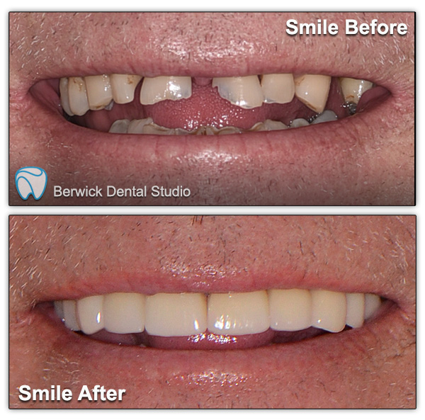 Dental-Veneers--case-1-Smile