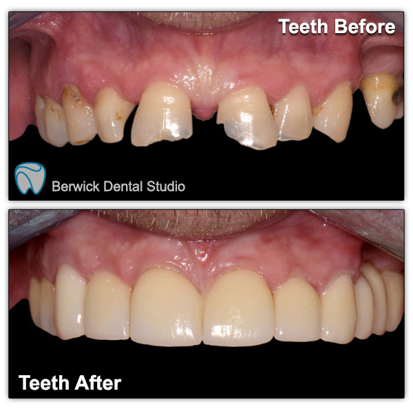 Dental-Veneers-case-1-upper-arch