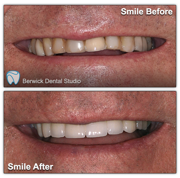 Dental-Veneers-case-2-Smile