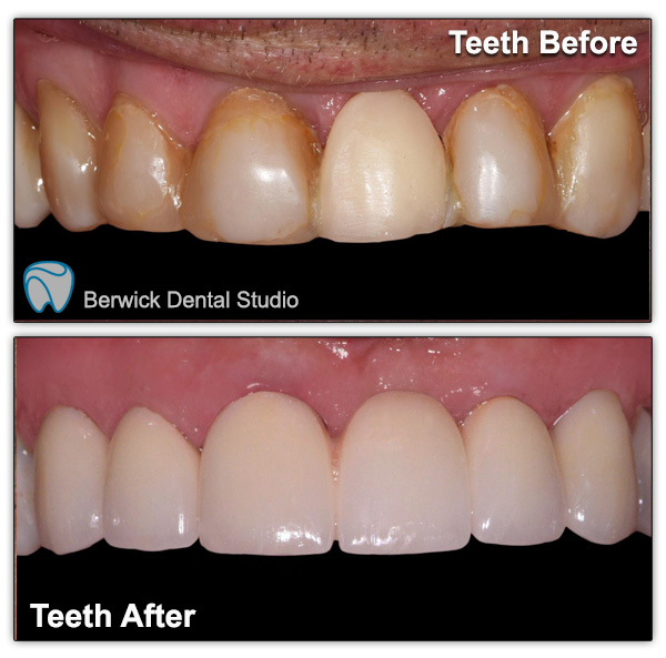 Dental-Veneers-case-2-upper-arch