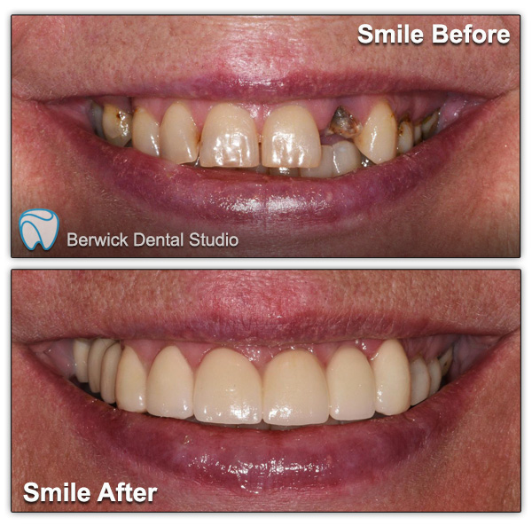Dental-Veneers-case-3-Smile