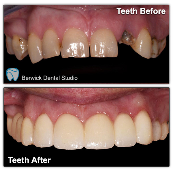 Dental-Veneers-case-3-Upper-arch