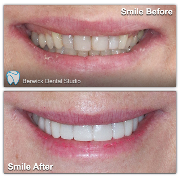 Dental-Veneers-case-5-Smile