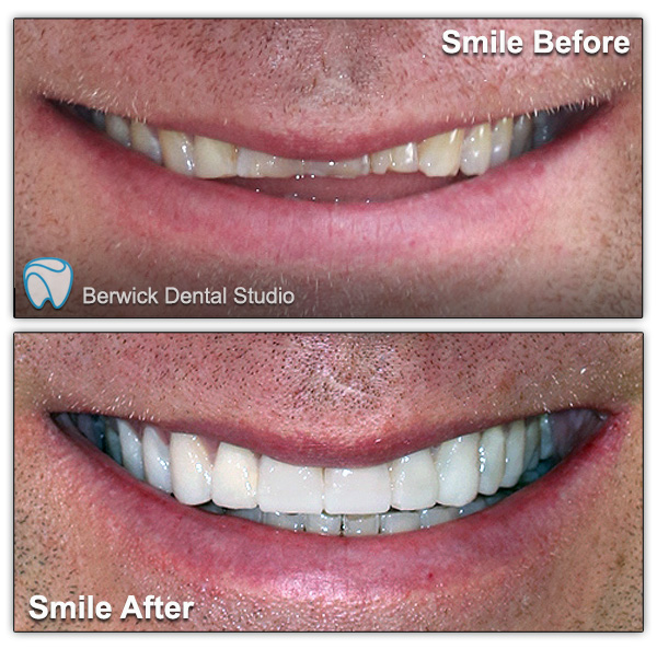 Dental-Veneers-case-6-Smile