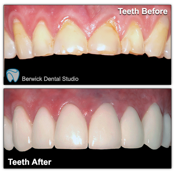 Dental-Veneers-case-6-Upper-arch