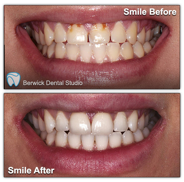 Dental-Veneers-case-7-Smile