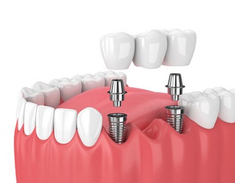 Multiple tooth dental implants