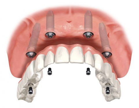 All-On-4 Dental Implants Upper Arch