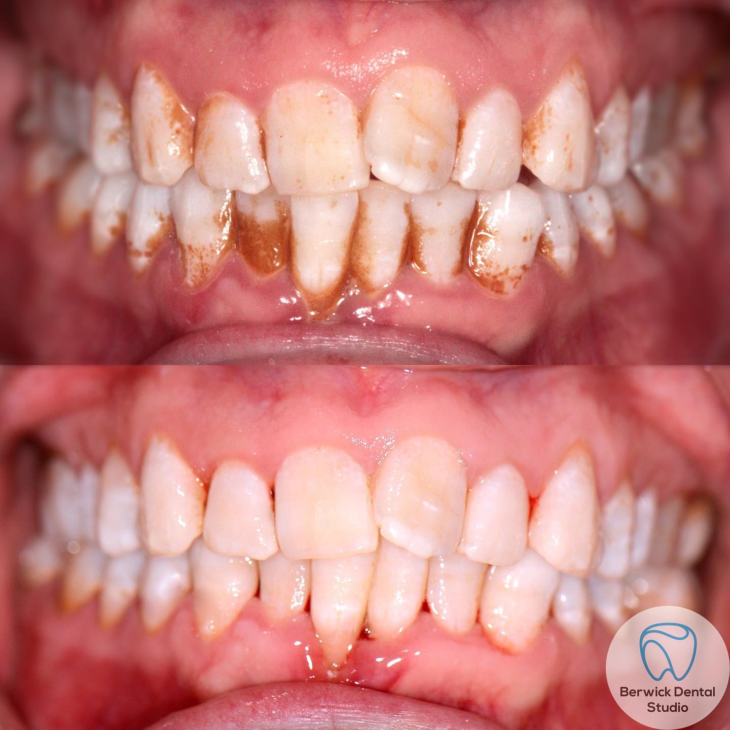 Teeth stains removal with EMS Airfow before and after